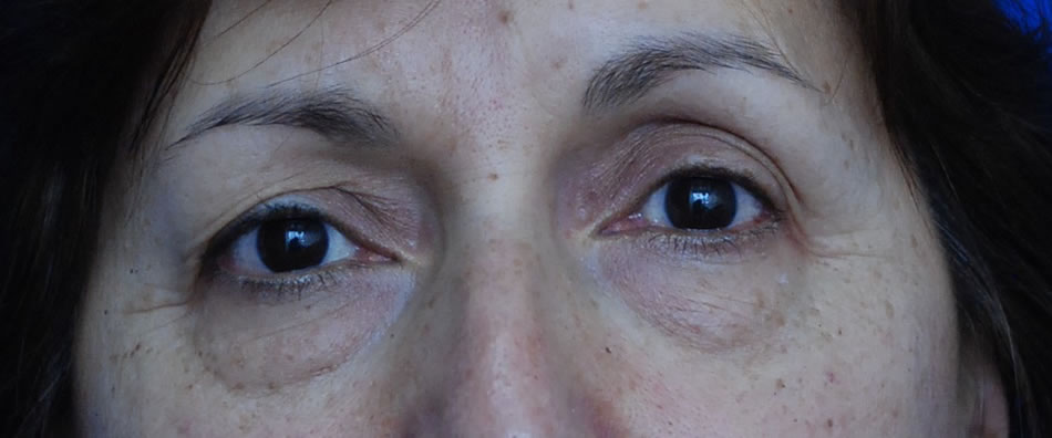 Blefaroplastia - Dr. Esteban Torres Cirujano Plástico Acreditado