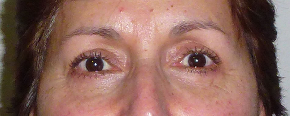 Blefaroplastia - Dr. Esteban Torres Cirujano Plástico Acreditado