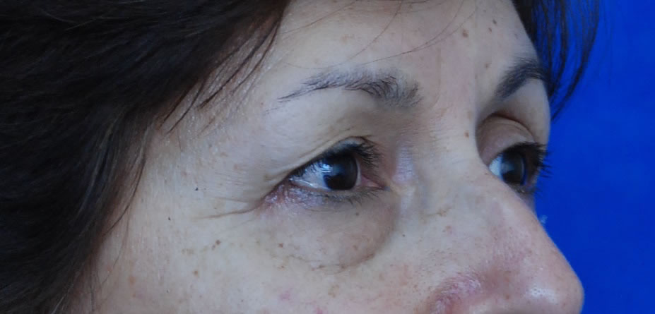 Blefaroplastia - Dr. Esteban Torres Cirujano Plástico Acreditado