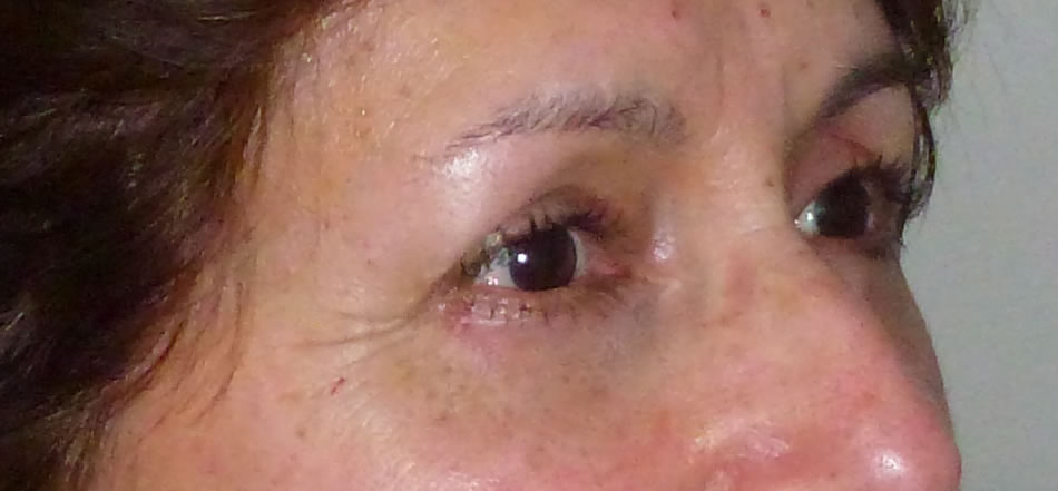 Blefaroplastia - Dr. Esteban Torres Cirujano Plástico Acreditado