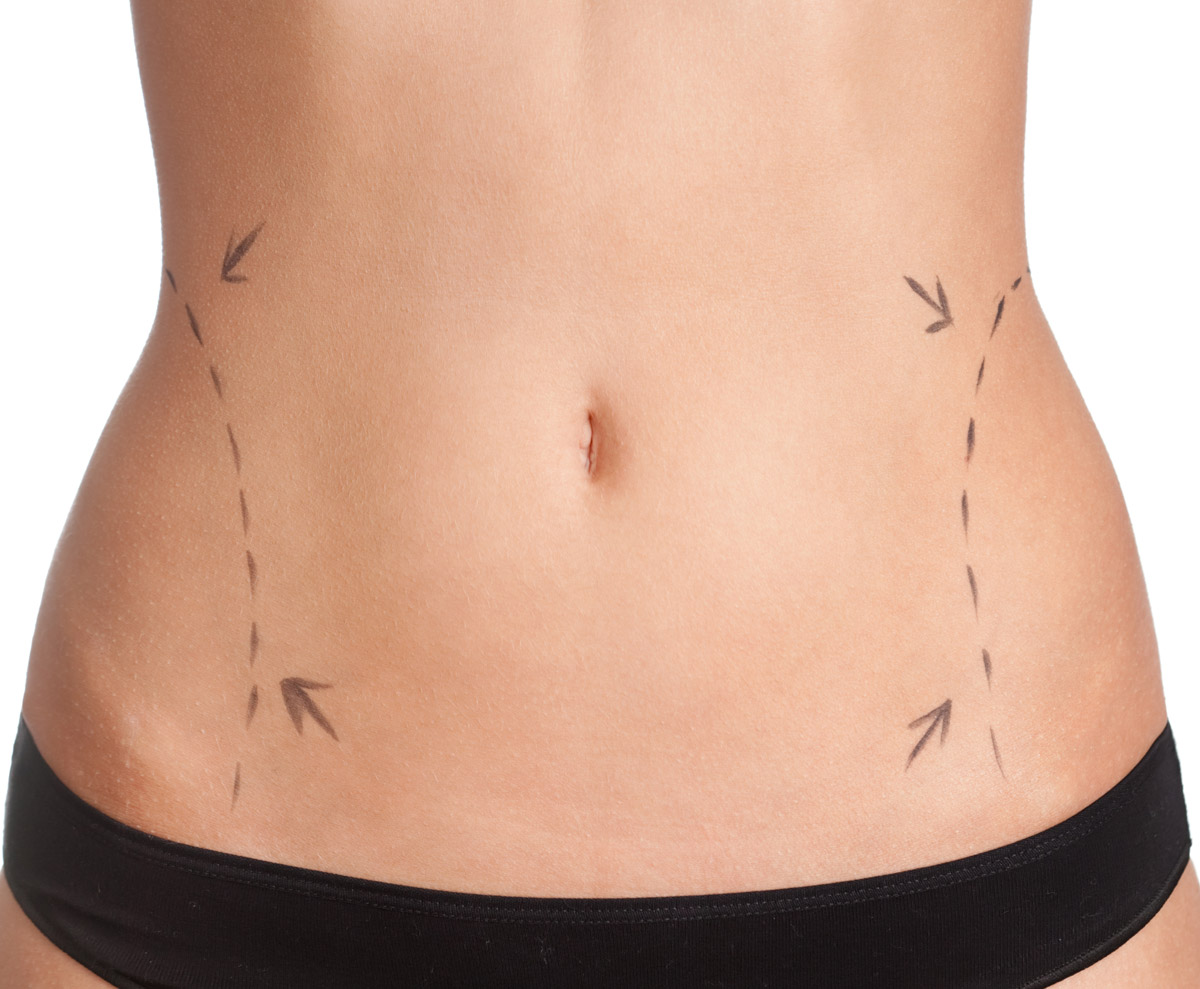 Imagen informativa sobre las contraindicaciones de la liposucción. Dr. Esteban Torres | Cirujano Plástico Santiago.