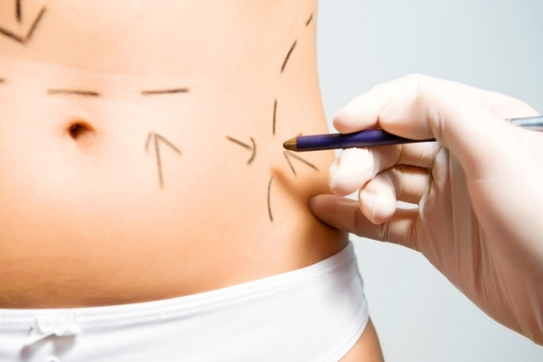 Imagen con beneficios de la liposucción realizada por el Dr. Esteban Torres, cirujano plástico en Santiago.