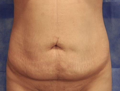 Abdominoplastia - Dr. Esteban Torres Cirujano Plástico Acreditado