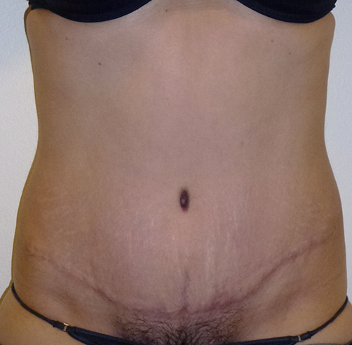 Abdominoplastia - Dr. Esteban Torres Cirujano Plástico Acreditado