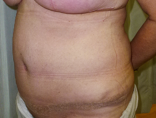 Abdominoplastia, Dr. Esteban Torres