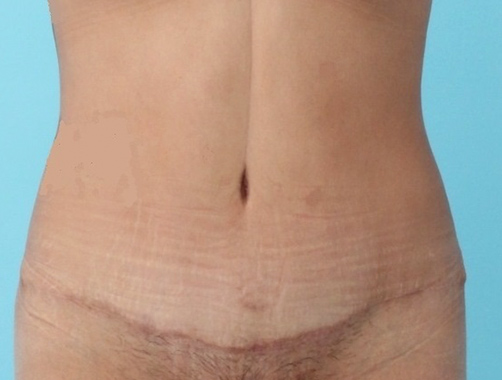 Abdominoplastia - Dr. Esteban Torres Cirujano Plástico Acreditado