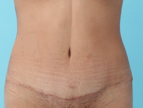 Abdominoplastia, Dr. Esteban Torres