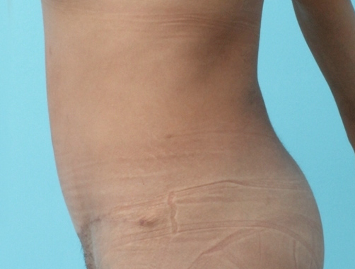Abdominoplastia - Dr. Esteban Torres Cirujano Plástico Acreditado