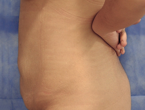 Abdominoplastia - Dr. Esteban Torres Cirujano Plástico Acreditado