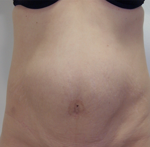 Abdominoplastia - Dr. Esteban Torres Cirujano Plástico Acreditado
