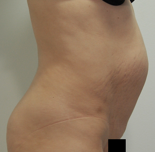 Abdominoplastia - Dr. Esteban Torres Cirujano Plástico Acreditado
