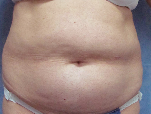 Abdominoplastia - Dr. Esteban Torres Cirujano Plástico Acreditado