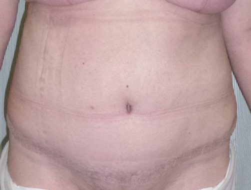 Abdominoplastia - Dr. Esteban Torres Cirujano Plástico Acreditado