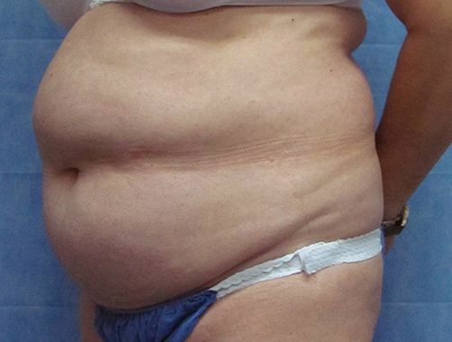 Abdominoplastia - Dr. Esteban Torres Cirujano Plástico Acreditado