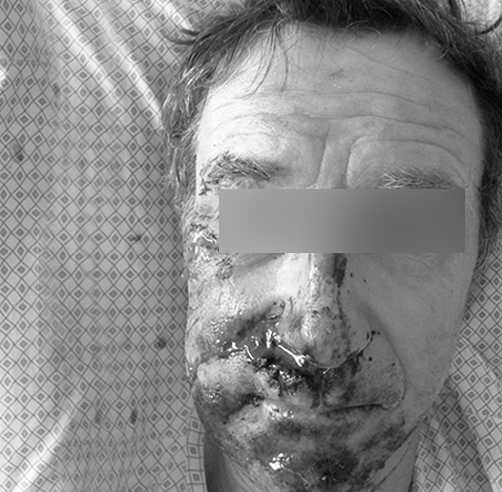 Trauma facial - Dr. Esteban Torres Cirujano Plástico Acreditado