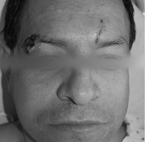 Mordedura humana - Dr. Esteban Torres Cirujano Plástico Acreditado