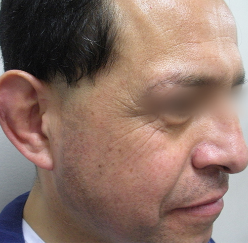Mordedura humana - Dr. Esteban Torres Cirujano Plástico Acreditado