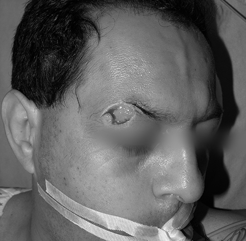 Mordedura humana - Dr. Esteban Torres Cirujano Plástico Acreditado