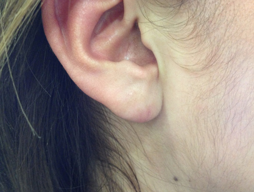 Lóbulo auricular - Dr. Esteban Torres Cirujano Plástico Acreditado