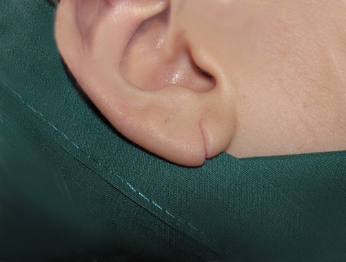 Lóbulo auricular - Dr. Esteban Torres Cirujano Plástico Acreditado
