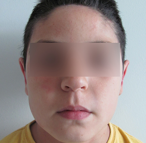 Otoplastia - Dr. Esteban Torres Cirujano Plástico Acreditado