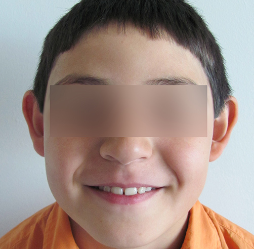 Otoplastia - Dr. Esteban Torres Cirujano Plástico Acreditado