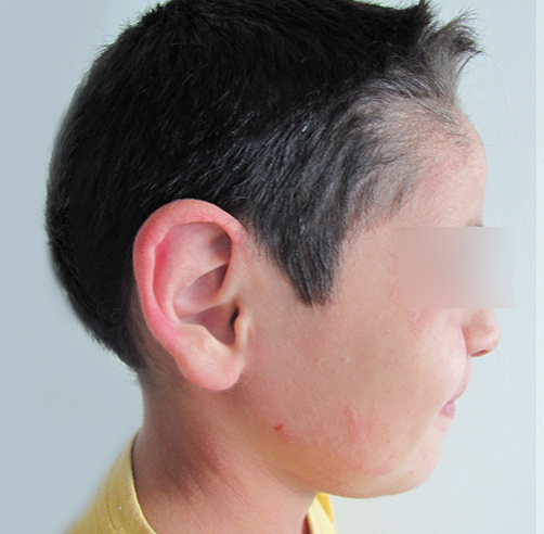 Otoplastia - Dr. Esteban Torres Cirujano Plástico Acreditado