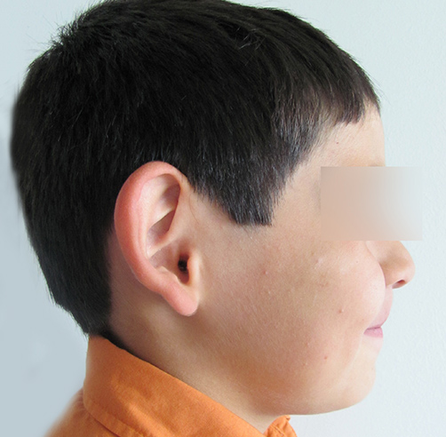 Otoplastia - Dr. Esteban Torres Cirujano Plástico Acreditado