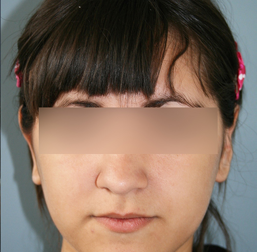 Otoplastia - Dr. Esteban Torres Cirujano Plástico Acreditado