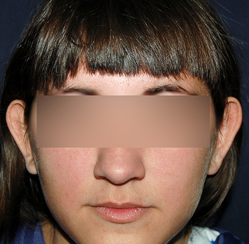 Otoplastia - Dr. Esteban Torres Cirujano Plástico Acreditado
