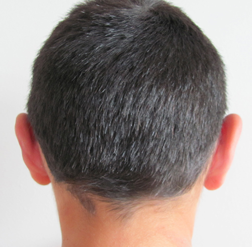 Otoplastia - Dr. Esteban Torres Cirujano Plástico Acreditado