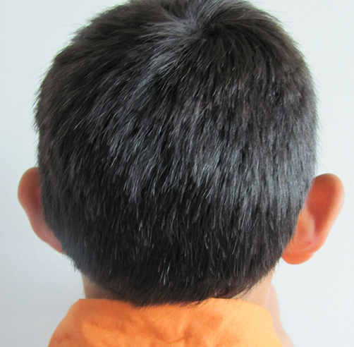 Otoplastia - Dr. Esteban Torres Cirujano Plástico Acreditado