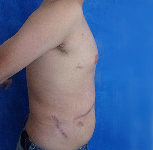 Reconstrucción abdominal - Dr. Esteban Torres Cirujano Plástico Acreditado