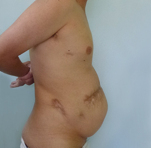 Reconstrucción abdominal - Dr. Esteban Torres Cirujano Plástico Acreditado