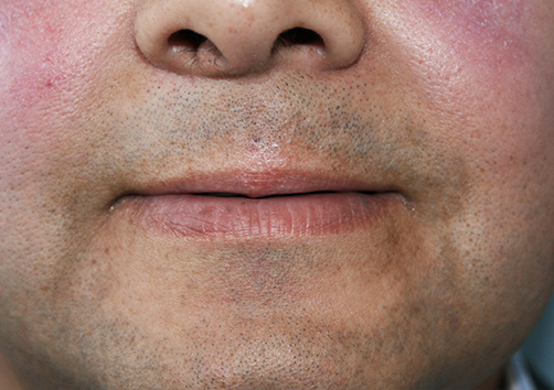 Reconstrucción Labial - Dr. Esteban Torres Cirujano Plástico Acreditado