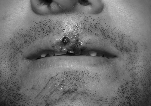 Reconstrucción Labial - Dr. Esteban Torres Cirujano Plástico Acreditado