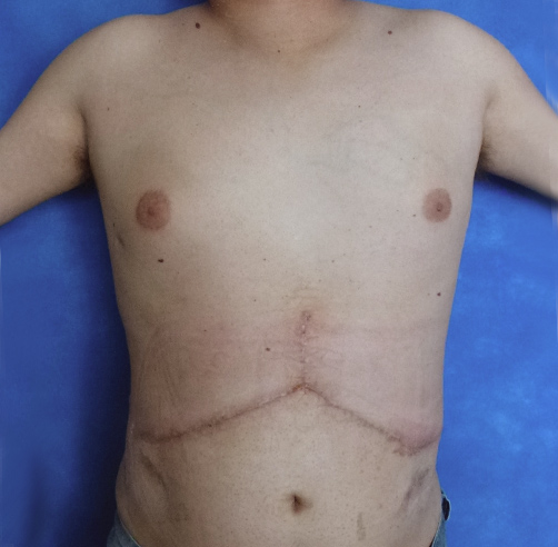 Reconstrucción abdominal - Dr. Esteban Torres Cirujano Plástico Acreditado