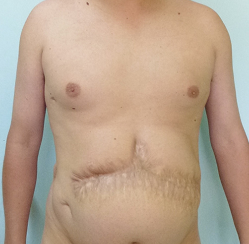 Reconstrucción abdominal - Dr. Esteban Torres Cirujano Plástico Acreditado