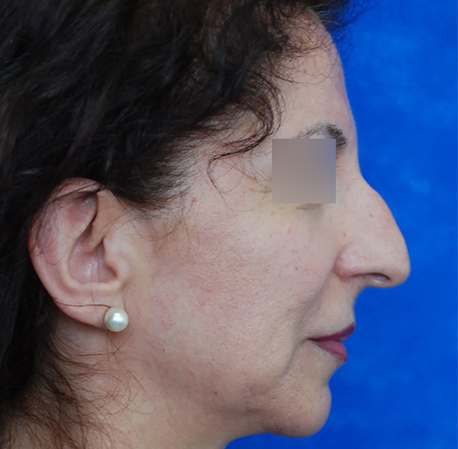 Rinoplastia - Dr. Esteban Torres Cirujano Plástico Acreditado