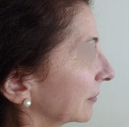 Rinoplastia - Dr. Esteban Torres Cirujano Plástico Acreditado