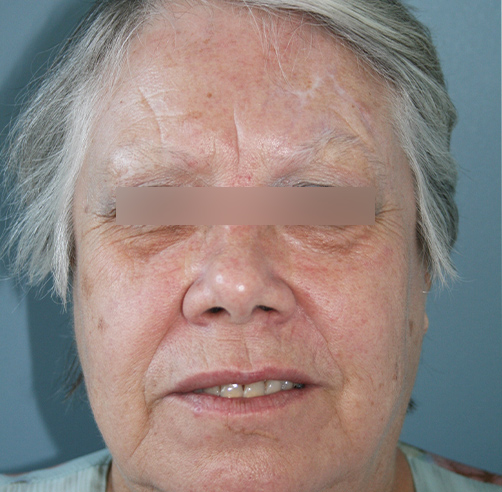 Trauma facial - Dr. Esteban Torres Cirujano Plástico Acreditado