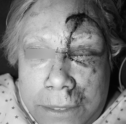 Trauma facial - Dr. Esteban Torres Cirujano Plástico Acreditado