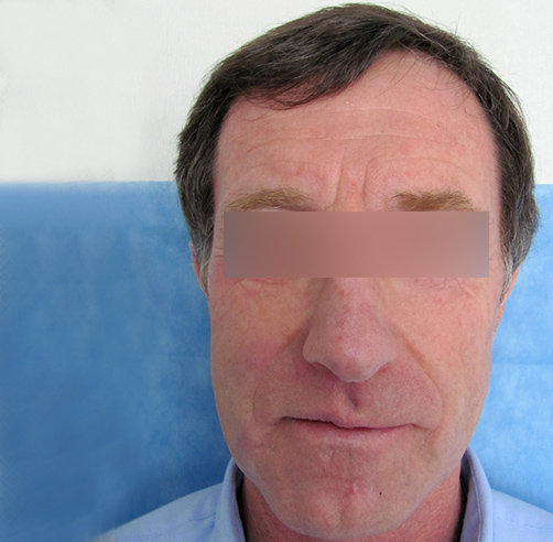 Trauma facial - Dr. Esteban Torres Cirujano Plástico Acreditado