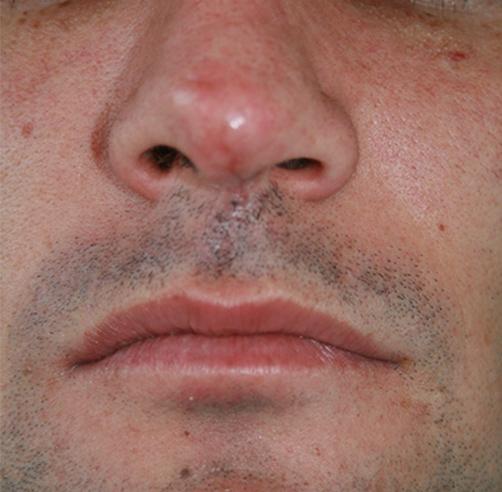 Trauma nasal - Dr. Esteban Torres Cirujano Plástico Acreditado