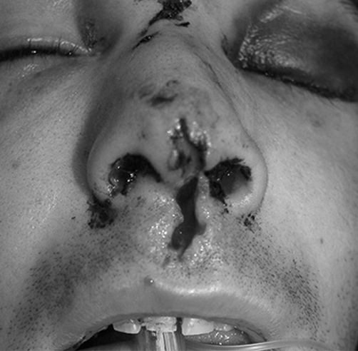 Trauma nasal - Dr. Esteban Torres Cirujano Plástico Acreditado