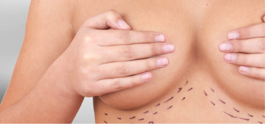 Aumento de mamas: técnica areolar, axilar o submamaria por Dr. Esteban Torres, Cirujano Plástico en Santiago.