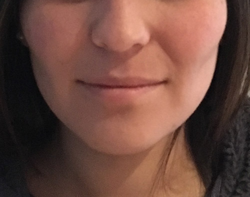 Adelgazamiento facial, bichectomía y Papada - Dr. Esteban Torres Cirujano Plástico Acreditado