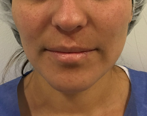 Adelgazamiento facial, bichectomía y Papada - Dr. Esteban Torres Cirujano Plástico Acreditado