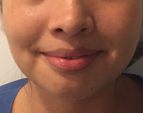 Adelgazamiento facial, bichectomía y Papada - Dr. Esteban Torres Cirujano Plástico Acreditado