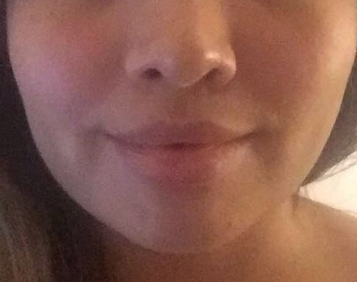 Adelgazamiento facial, bichectomía y Papada - Dr. Esteban Torres Cirujano Plástico Acreditado
